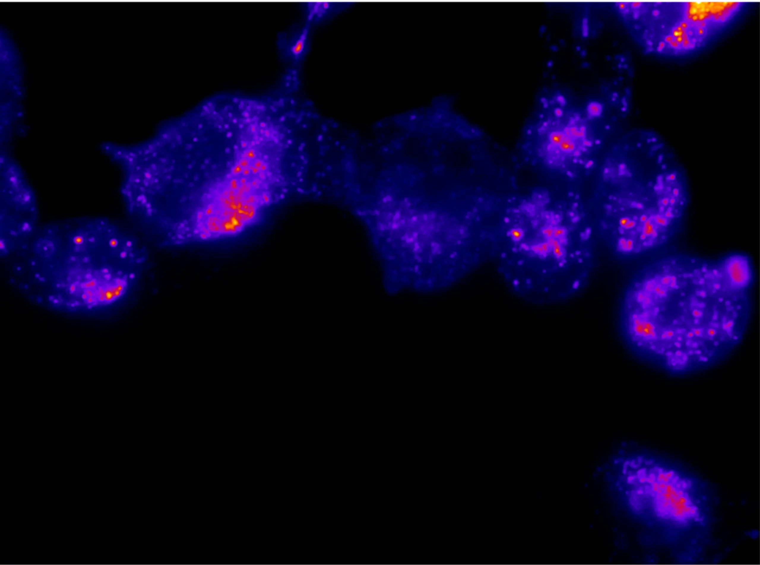 Tumor cells labelled by the tracer