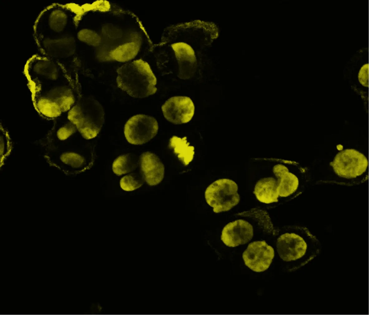 Tumor cells revealed by fluorescence