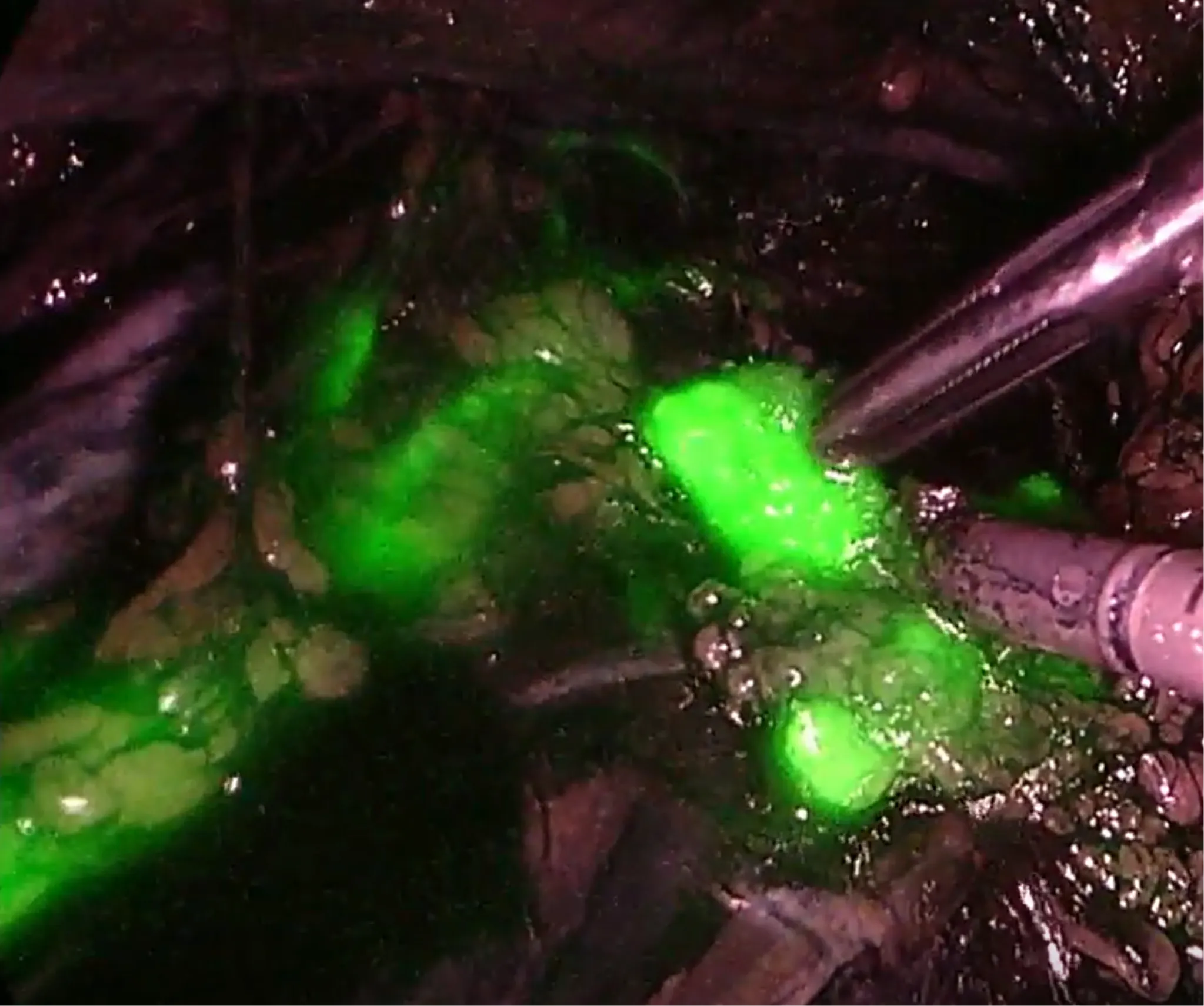 Fluorescence visualization during surgery